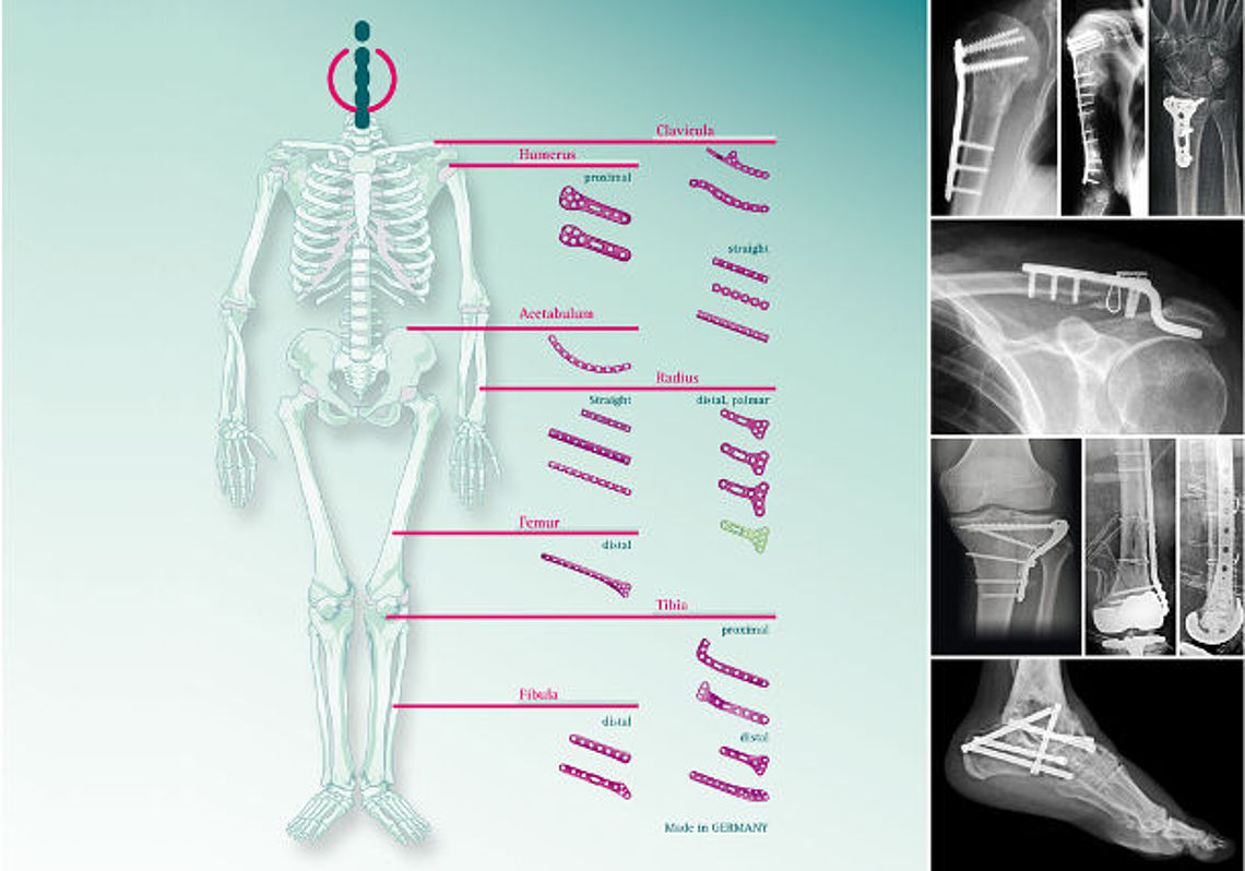Implantate und Medizinprodukte von Intercus Implantate und Medizinprodukte von Intercus